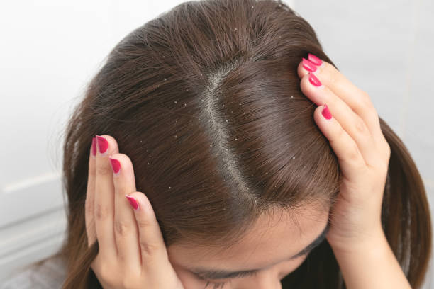 Read more about the article how to get rid of dandruff